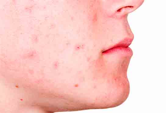 Expigment Krem Ne İşe Yarar?